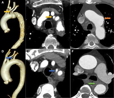 Endovascular repair of thoracic aortic disease with isolated left vertebral artery and unfavorable proximal landing zone using fenestrated castor stent-graft